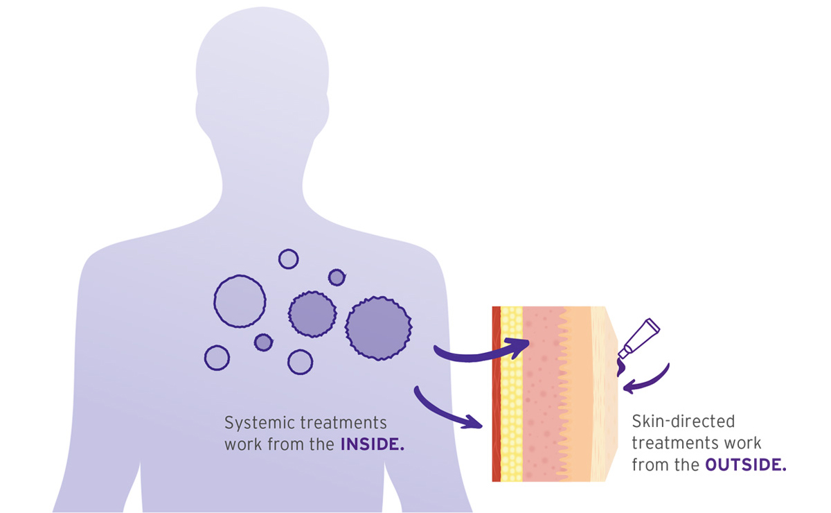 Graphic showing silhouette of the body representing the difference between systemic treatments and skin-directed treatments.