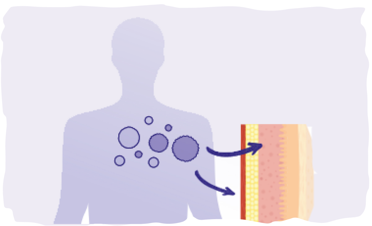 Graphic representation of cells and their relation to CTCL skin symptoms.