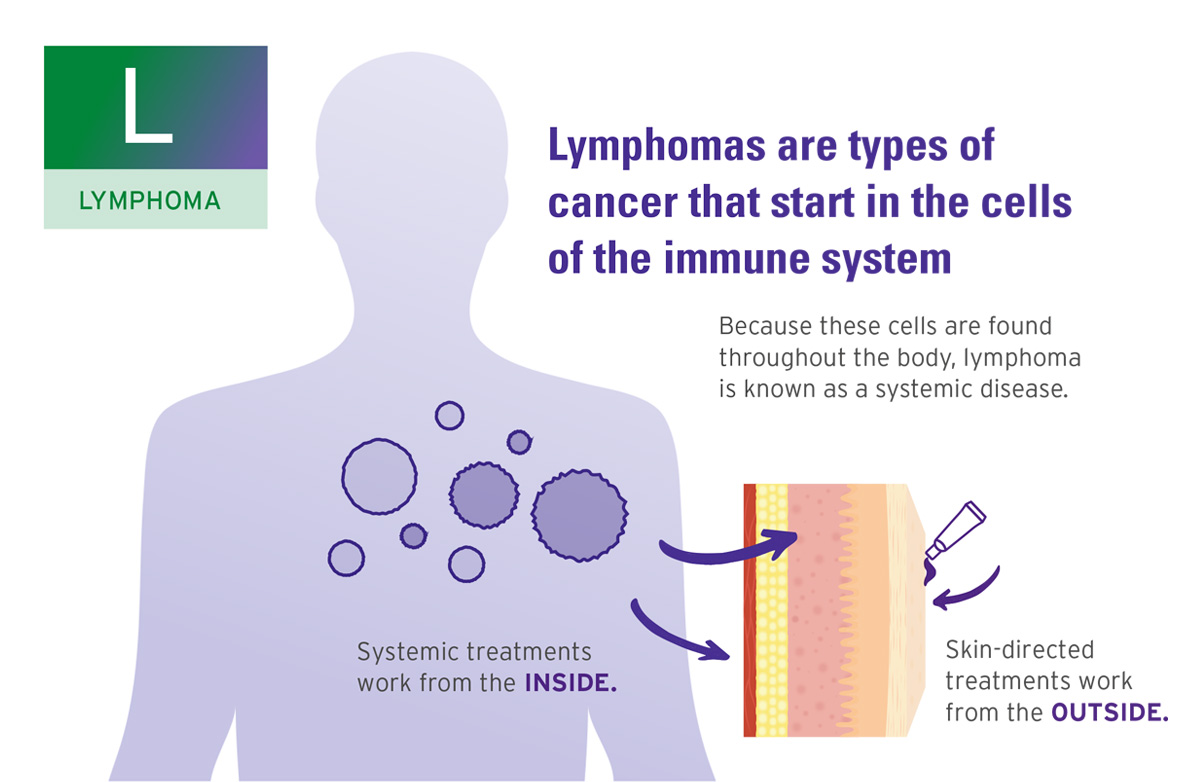 Microscopic slide displaying Lymphoma cells for educational purposes.