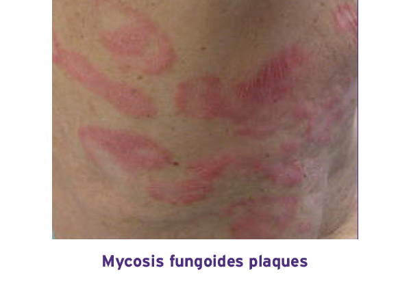 Image of skin showing plaques associated with Mycosis Fungoides.